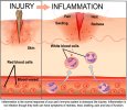 IMAGE injury-inflammation.jpg
