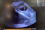Gallbladder.jpg Gallbladder.jpg